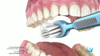 Higiene dental  Clinica identis [upl. by Grimaldi]