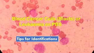 Blood Cancer Cells  Blasts or Leukemia on Peripheral Blood Smear Observation and Identifications [upl. by Inalan]