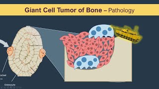 Giant cell tumor of Bone Osteoclastoma  Pathology [upl. by Atekram]