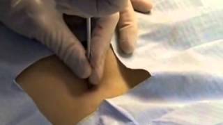 Core Needle Biopsy Technique [upl. by Rosa]