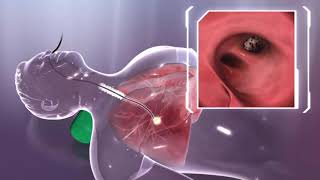 Quelles sont les causes de lépanchement pleural [upl. by Bouzoun]