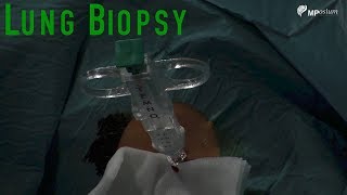 Day 5 Embryo Biopsy [upl. by Nelac428]