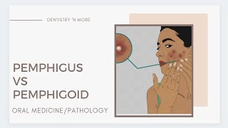 PEMPHIGUS VS PEMPHIGOID [upl. by Edin739]