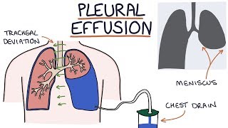 Understanding Pleural Effusions [upl. by Jacklyn]