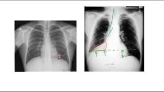 🔴 PNEUMONIE PLEURESIE INFARCTUS OU ATELECTASIE [upl. by Rubio]