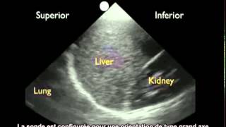 Comment  Détecter un épanchement pleural à laide dune échographie [upl. by Whitebook392]