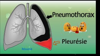 💨 Pneumothorax 🆚 Pleurésie 💧  Résumé  PneumoPhtisiologie [upl. by Suivatnad]