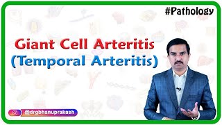 Giant cell arteritis Temporal arteritis Vasculitis Pathology  Usmle Step 1 [upl. by Ecidnak405]